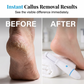 Electric Foot Callus Remover